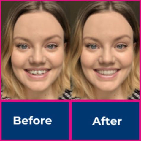 Invisalign - before_after